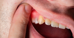 Abscessed Tooth Treatment