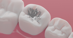 Broken Dental Filling