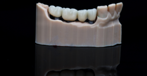 Emergency Dental Bridges in Cincinnati