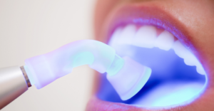 Dental Filling - Emergency Dental of Cincinnati