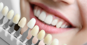 Teeth Whitening